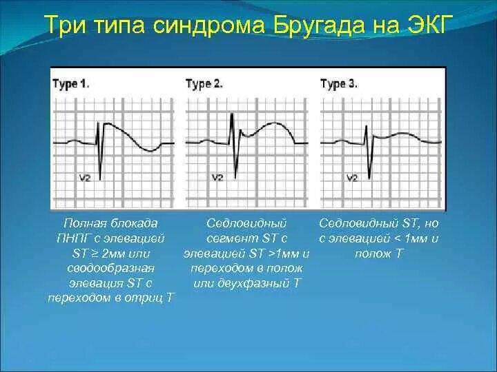 Экг-критерии синдрома бругада 3 типа. Бругада экг признаки. Экг-критерии синдрома бругада 3 типа. Синдром бругада 3 тип на экг. Экг картина синдрома бругада.
