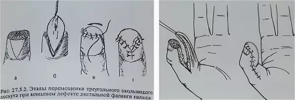 Травматическая ампутация ногтевой фаланги. Экзартикуляция ногтевой фаланги. Частичная травматическая ампутация ногтевой фаланги. Экзартикуляция фаланг пальцев кисти.