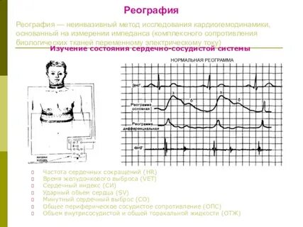 Реограмма
