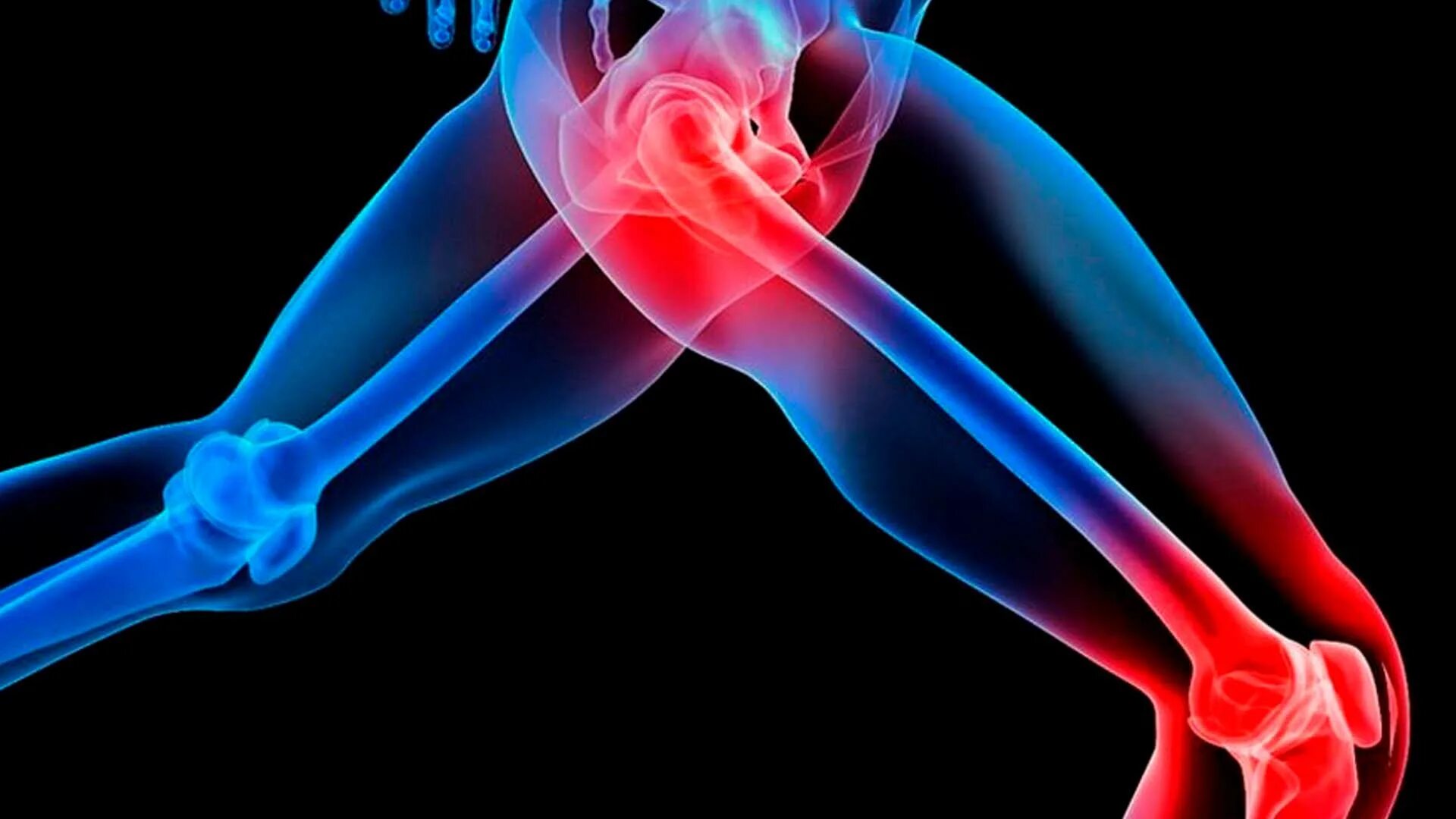 Ревматоидный артрит тофусы. Хруст в костях и суставах. Ревматоидный артрит пястно фаланговый. Хруст костей. Суставы.