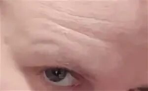 На голове появилась ямка