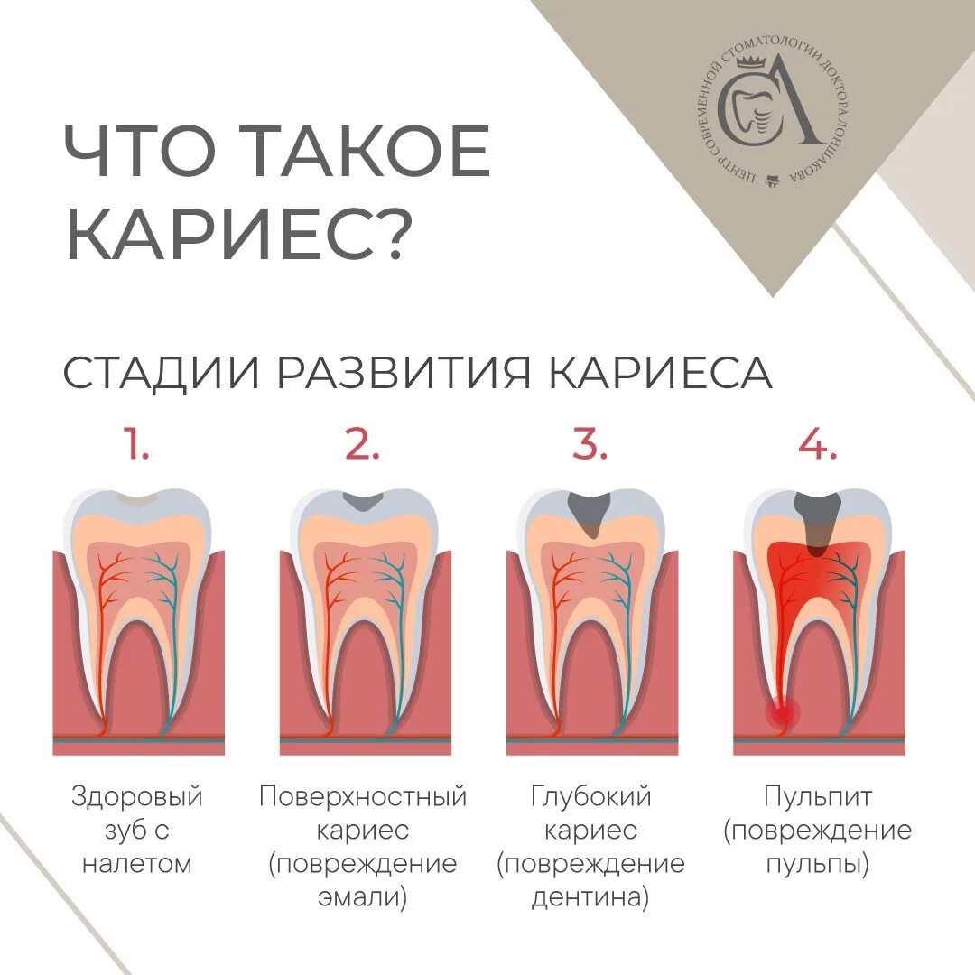 Сколько развивается кариес. Распространение кариеса. кариозные поражения зубов. заболеваемость кариесом называют.
