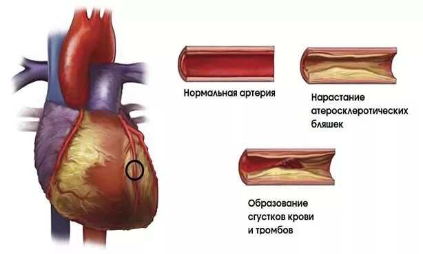 Ишемическая болезнь сосудов. Атеросклеротическая болезнь сердца. ИБС атеросклеротическая болезнь сердца. Осложнения атеросклероза венечных артерий. ИБС атеросклеротическая бляшка.