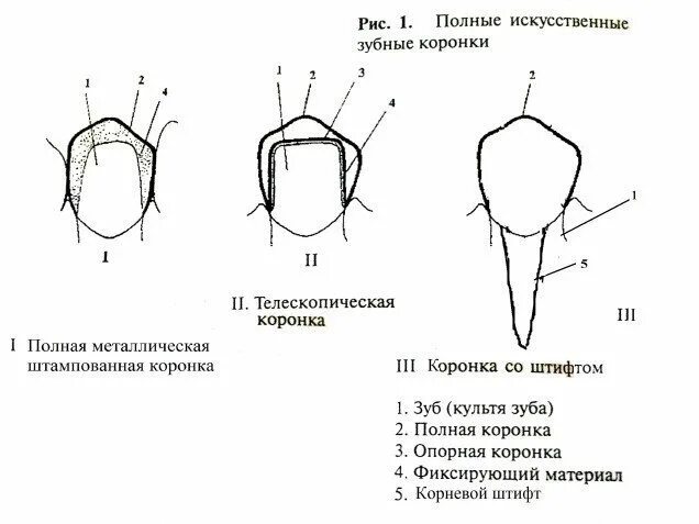 Телескопическая коронка схема. Телескопическая коронка с фрикционным штифтом. Телескопическая коронка с фрикционным штифтом рисунок. Препарирование под телескопическую коронку. Какую функцию выполняет коронка зуба