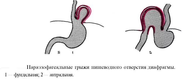 Грыжа рвота. Грыжи гпод классификация. параэзофагеальная грыжа пищеводного отверстия диафрагмы. скользящие и параэзофагеальные грыжи пищеводного отверстия. классификация скользящих грыж пищеводного отверстия диафрагмы.