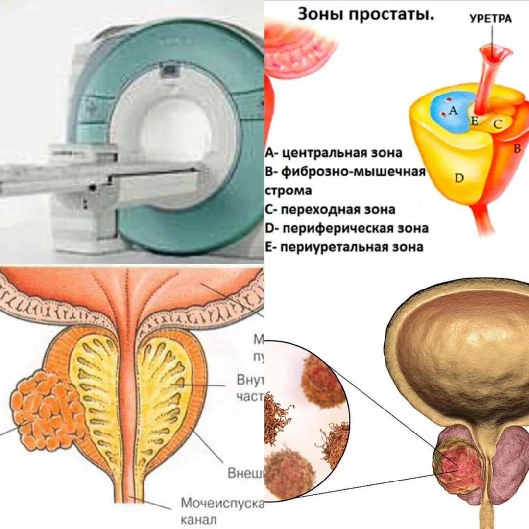 Схема простаты. Фибромускулярная Строма предстательной железы это. Предстательная железа анатомия зоны. Периферическая зона предстательной железы. Транзиторная зона предстательной железы схема.