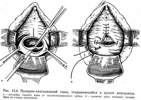 Влагалищный свищ