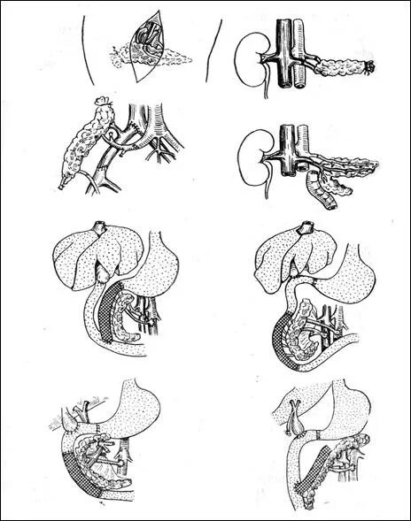 Пересадка поджелудочной при диабете. Трансплантация эндокринных желез. Трансплантация поджелудочной железы. Трансплантология поджелудочной железы. Органная трансплантация поджелудочной железы.