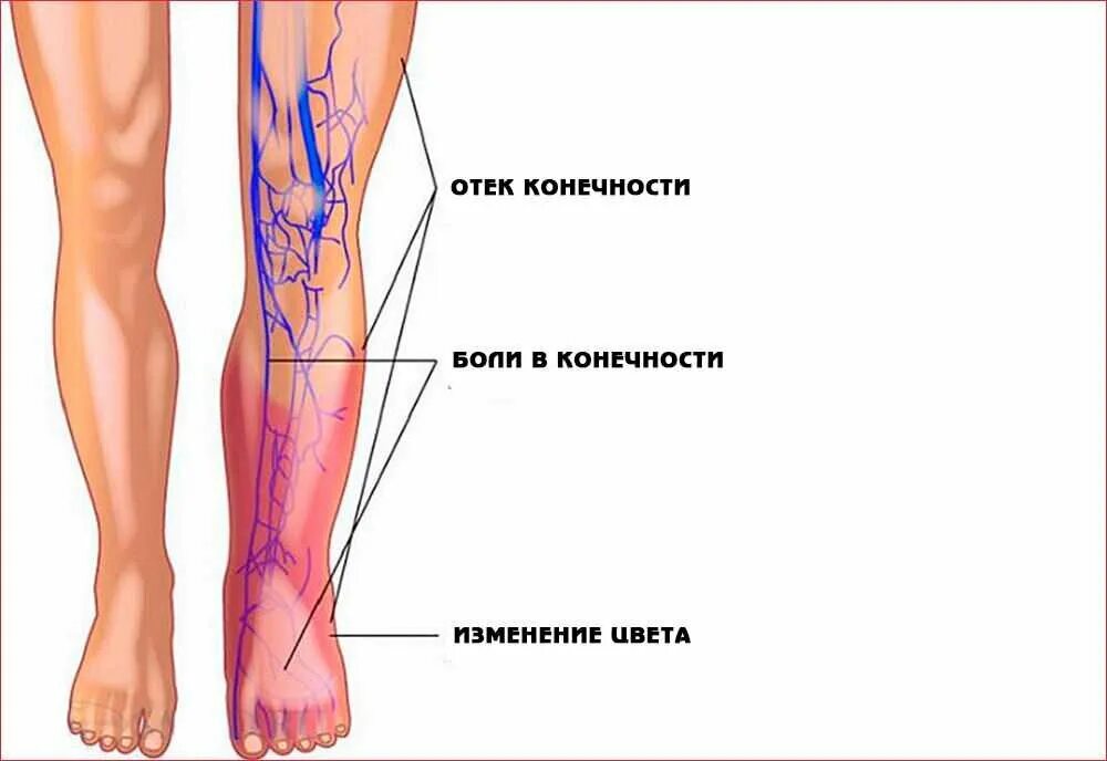 Поверхностный флебит, тромбофлебит. Флебит – воспаление вены. Флеботромбоз голени клиника. Тромбоз поверхностных артерий нижних конечностей. Симптомы образования тромба