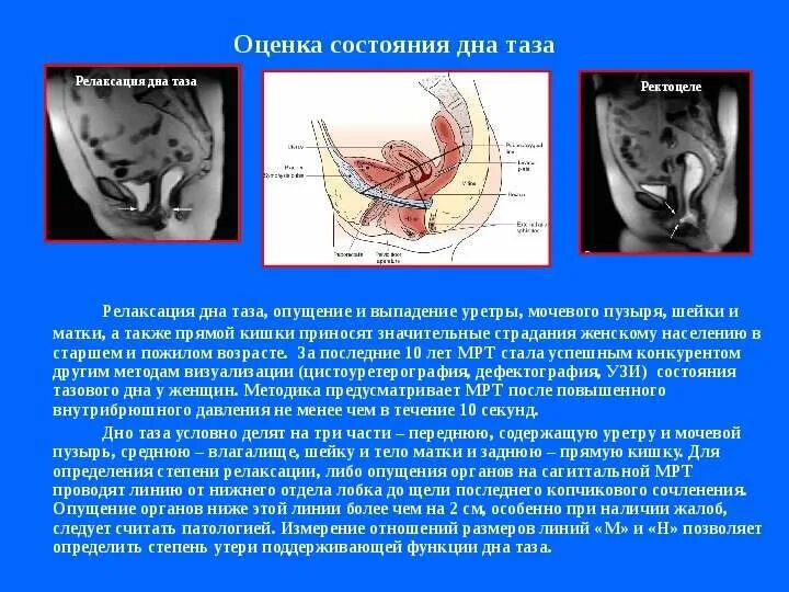 Смоленцева Н.В."МР патологических изменений структур тазового дна у женщин при н