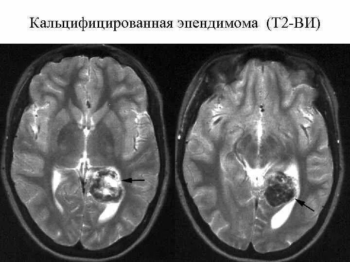 Опухоли желудочков. Глиальная астроцитома. Эпендимома желудочка головного мозга. Эпендимома анапластическая эпендимома. Злокачественная эпендимома головного мозга.