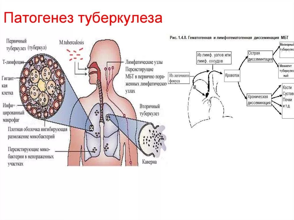 Патогенез первичного туберкулеза схема. Патогенез вторичного туберкулеза схема. Схема патогенеза туберкулезной инфекции. Патогенез первичного туберкулеза лёгких.