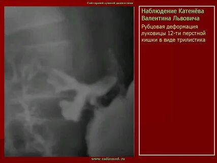 Деформация 12 перстной кишки