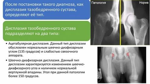 Воспаление тазобедренного сустава у ребенка