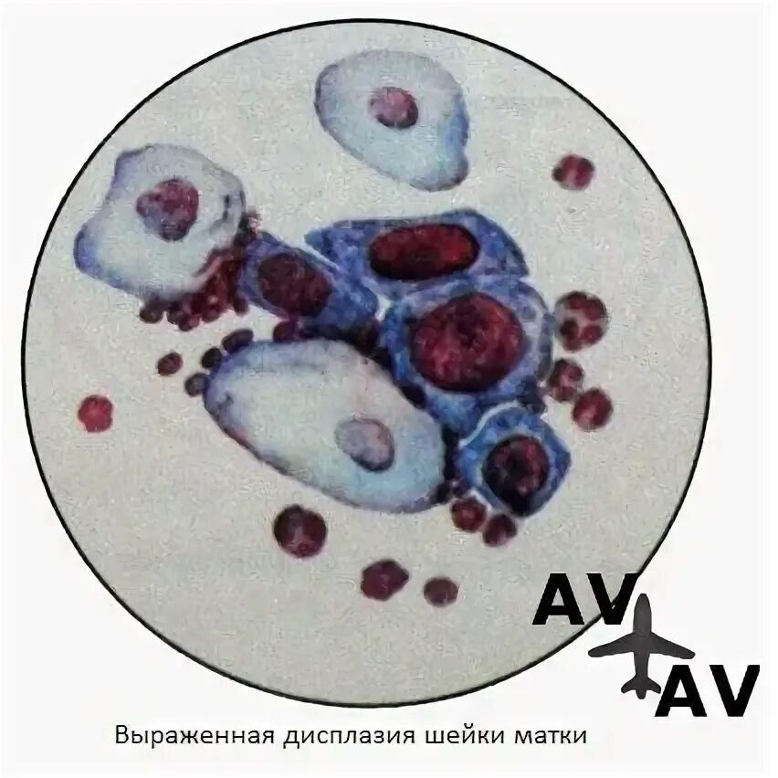 Дисплазия 2 степени цитология. Дисплазия по цитологии. Дисплазия по цитологии. Цитология при дисплазии. Цилиндрический эпителий шейки матки цитология.