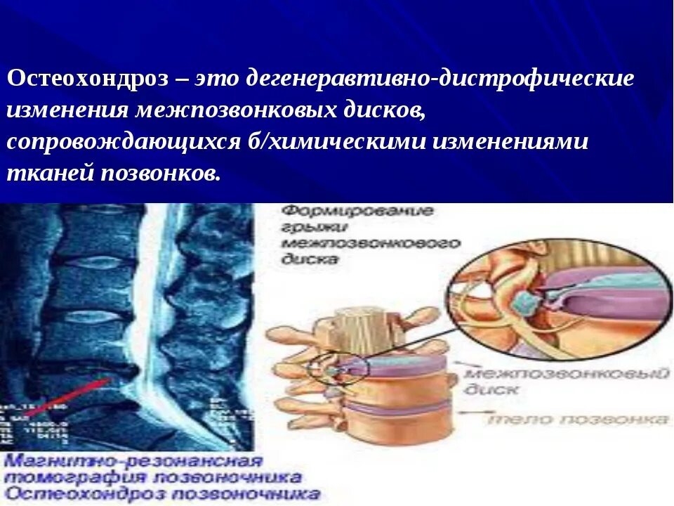 Дистрофические изменения позвоночника. Поясничный остеохондроз симптомы. Дистрофические изменения. Воспаление межпозвонкового диска. Дегенеративно-дистрофические изменения легких.