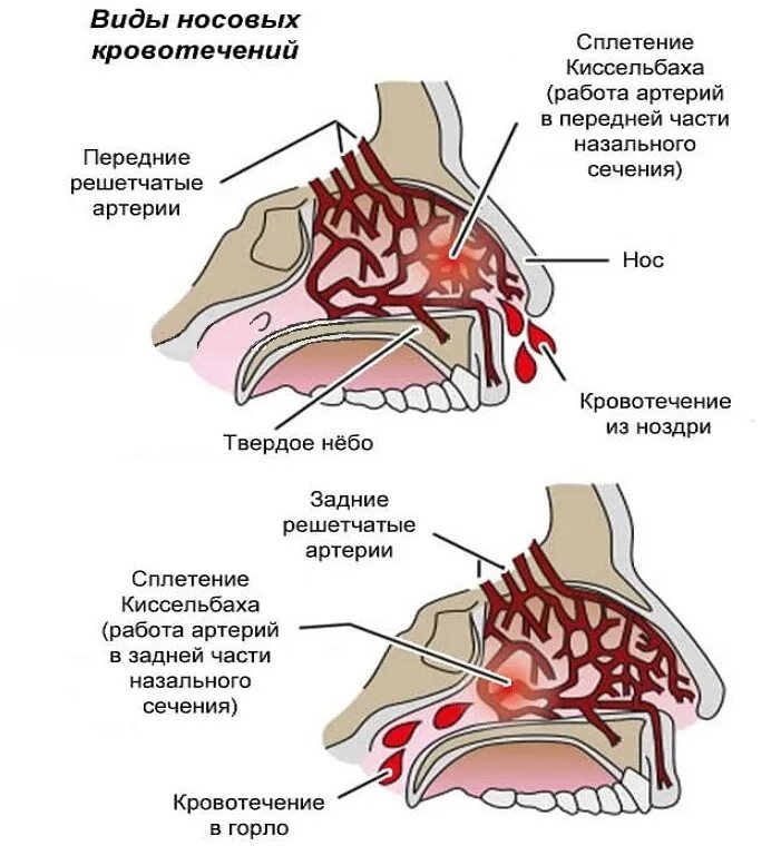 Нососове кровотечение. Причины кровотечения из носа.