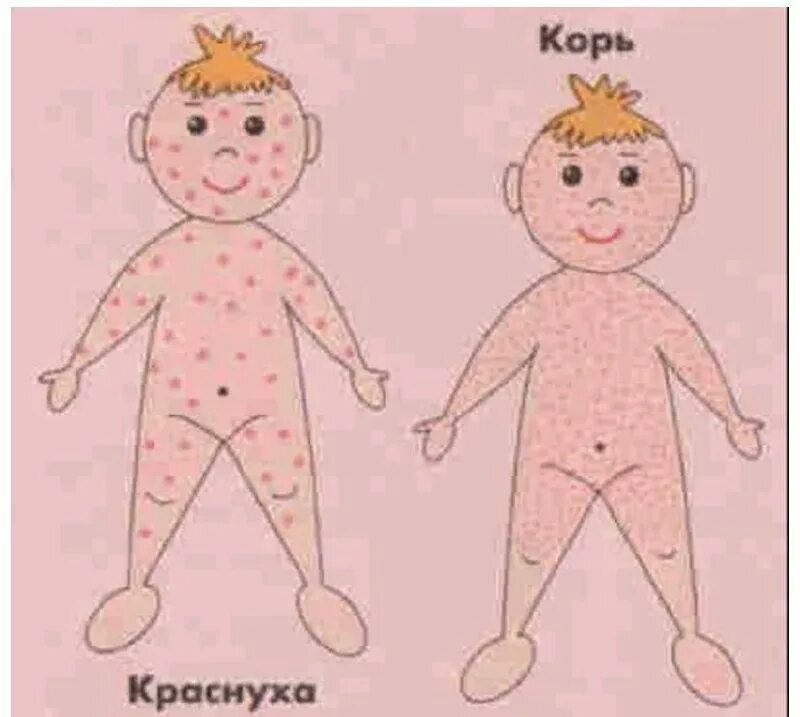 сыпь краснуха краснуха сыпь. ветрянка корь краснуха различия сыпи. сыпь корь краснуха сыпь. чем отличается ветрянка от кори. корь ветрянка краснуха таблица.