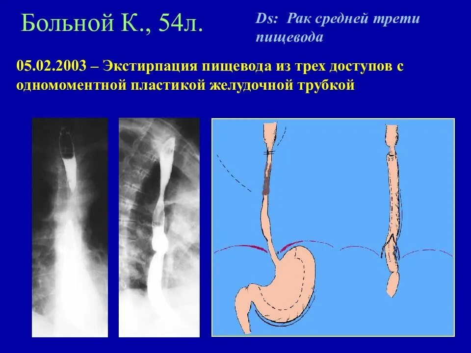 Два пищевода