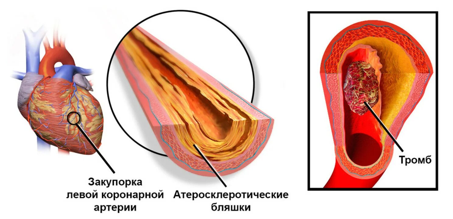 Тромб в желудочке