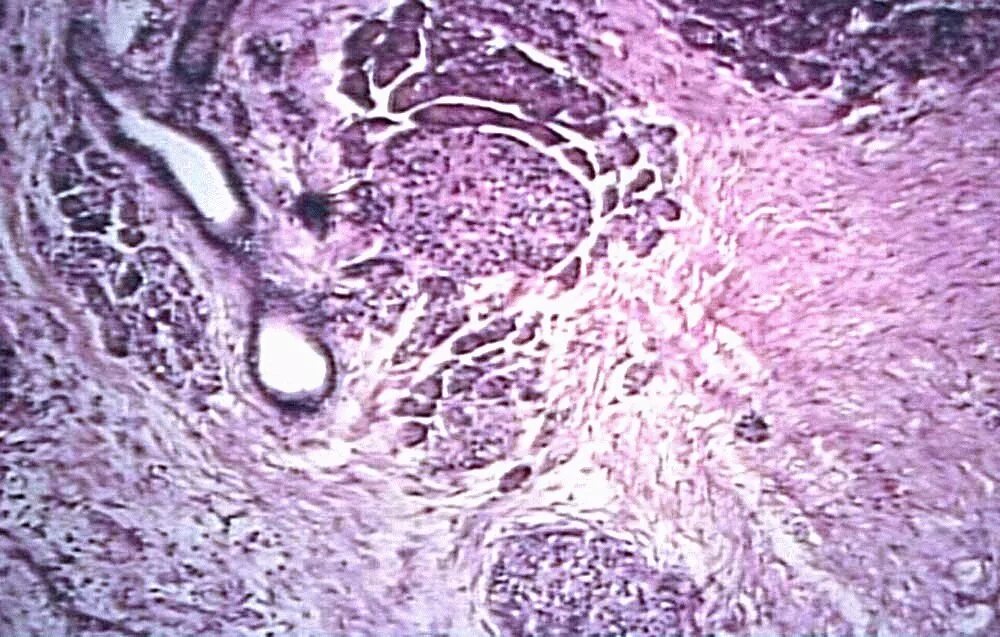 Поджелудочная железа фиброзные изменения. Хронический индуративный панкреатит гистология. Псевдотуморозный панкреатит гистология. Панкреонекроз гистология препарат. Жировой панкреонекроз гистология.