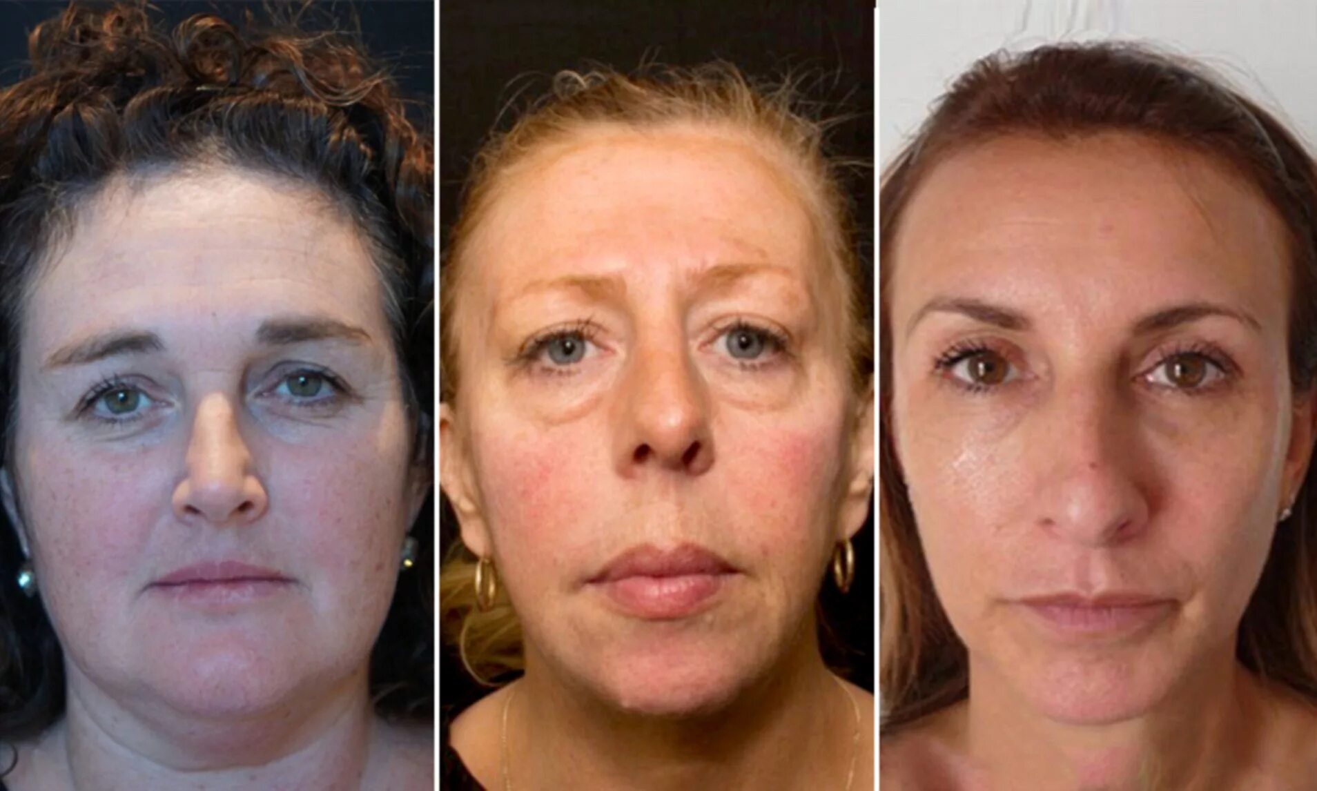 Филлеры на лице через 10 лет. Лицо после филлеров. Пластика лица спустя 10 лет. Гиперкоррекция филлерами.