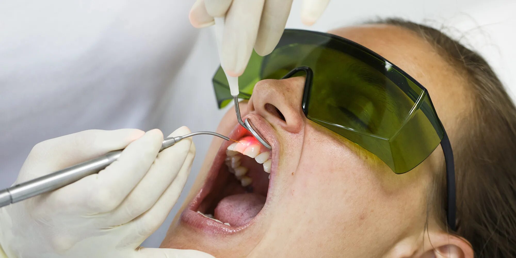 Аргоновый лазер в стоматологии. Лазерный метод препарирования кариозных полостей. Препарирование зуба лазером. Отбеливание зубов в стоматологии. Лазеротерапия в стоматологии.