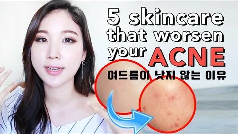 If you’re acne, you should be careful on your acne. 