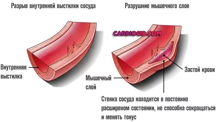 Разрыв кровеносного сосуда. Дефект сосудистой стенки. Внутренний разрыв сосуда. Стенка артерии. Повреждение сосудистой стенки.