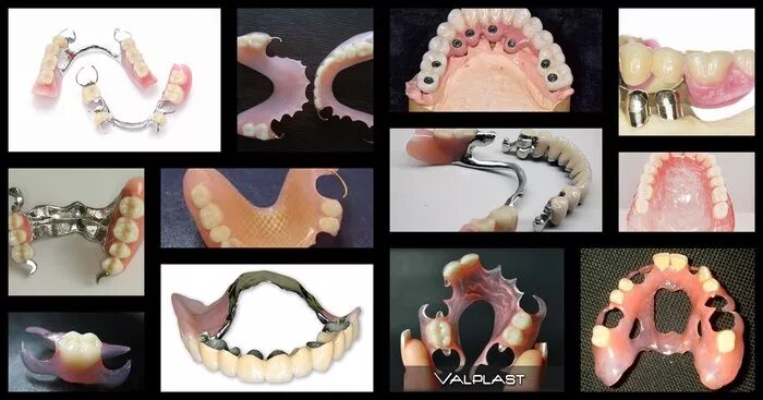 Бюгельный протез (1 челюсть)+кламмер. Несъемные бюгельные протезы. Протез зубной бюгельный Нижний. Бюгельный протез ортопедическая стоматология. Как крепятся съемные