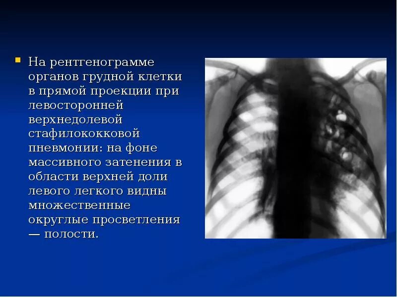 Рентген органов грудной клетки пневмония. Рентгенография крупозной пневмонии. Пневмония верхней доли левого легкого рентген. Очаговая пневмония рентгенография ОГК. Изменения в верхней доле легкого