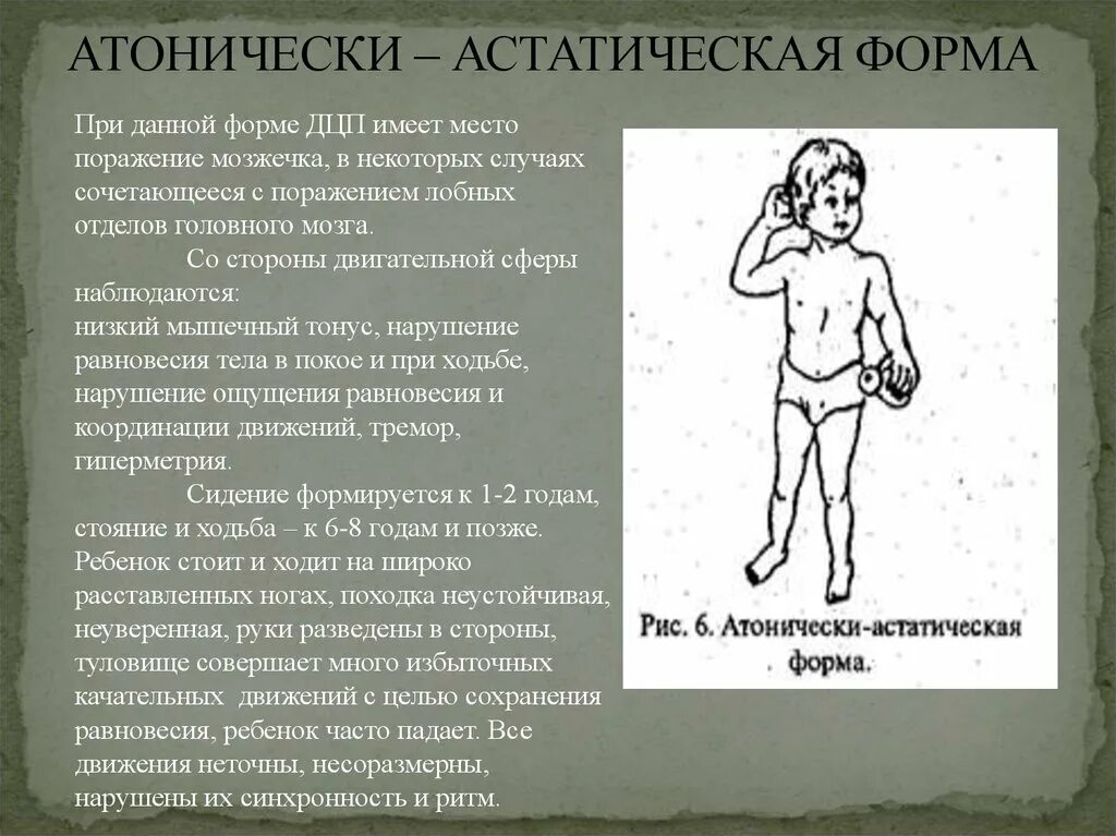 Церебрально дцп детский церебральный. Формы ДЦП. ДЦП легкая форма. ДЦП легкая форма симптомы. Дети с ДЦП.