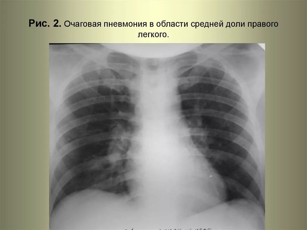 Очагово сливная пневмония рентген. Очаговая пневмония рентген. Очаговая пневмония рентгенограмма. Очаговые тени пневмонии. Пневмония в нижней доле правого легкого
