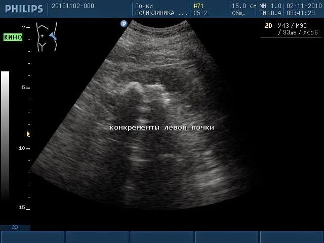 Гиперэхогенные включения в желчном пузыре. Коралловидный камень в почке УЗИ. Коралловидный конкремент почки УЗИ. Коралловидный камень на УЗИ. Конкременты в почках на УЗИ что это такое.
