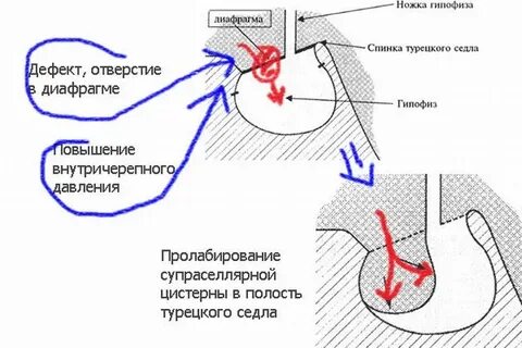 Пустое турецкое седло симптомы у женщин