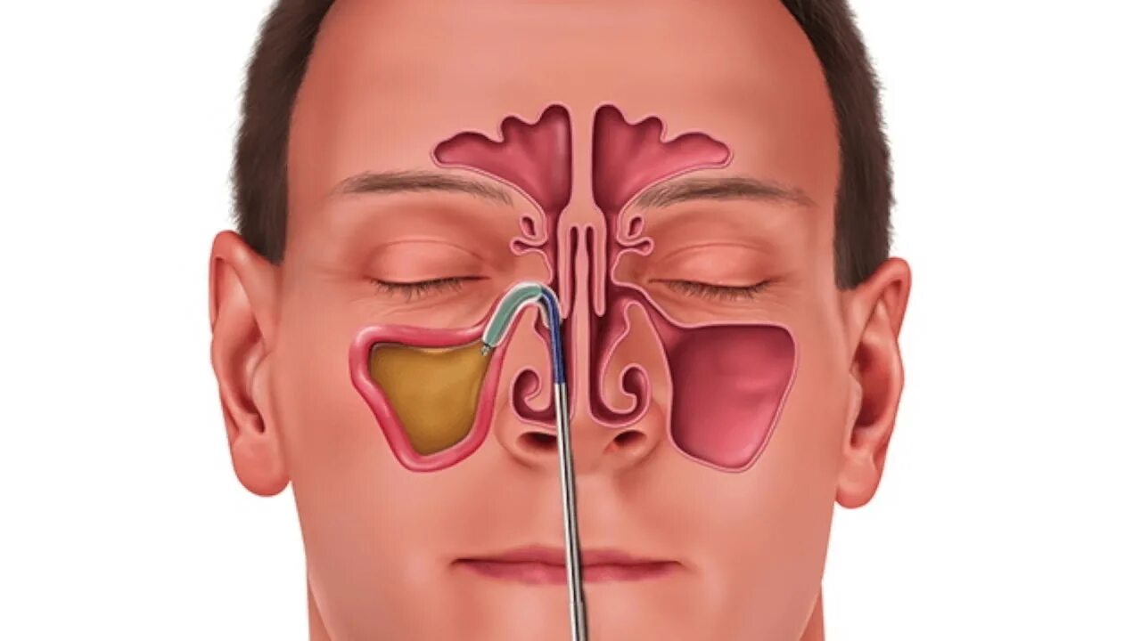 Синусит можно греть нос. Синусит гайморит фронтит. Воспаление околоносовых пазух. Пункция верхнечелюстной пазухи.