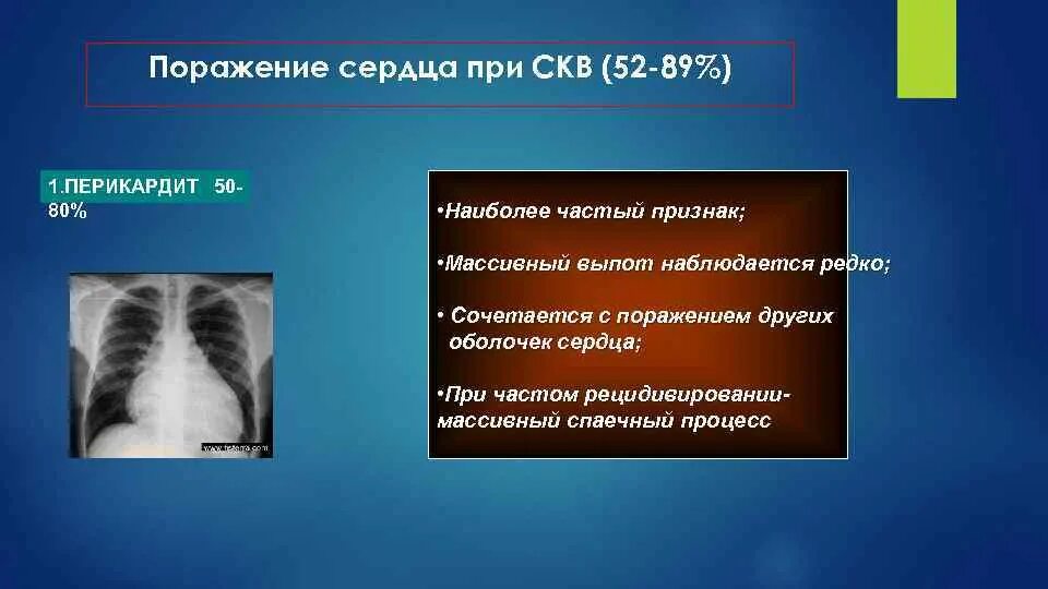 Системная красная волчанка склеродермия. Красная волчанка легких. Системная красная волчанка перикардит. Красная волчанка легких. Идиопатический пневмонит.