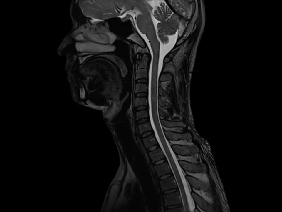 Магнитно-резонансная томография шейного отдела позвоночника. Мрт шейного отдела позвоночника. Мрт шейного отдела позвонка. Мрт мягких тканей спины.