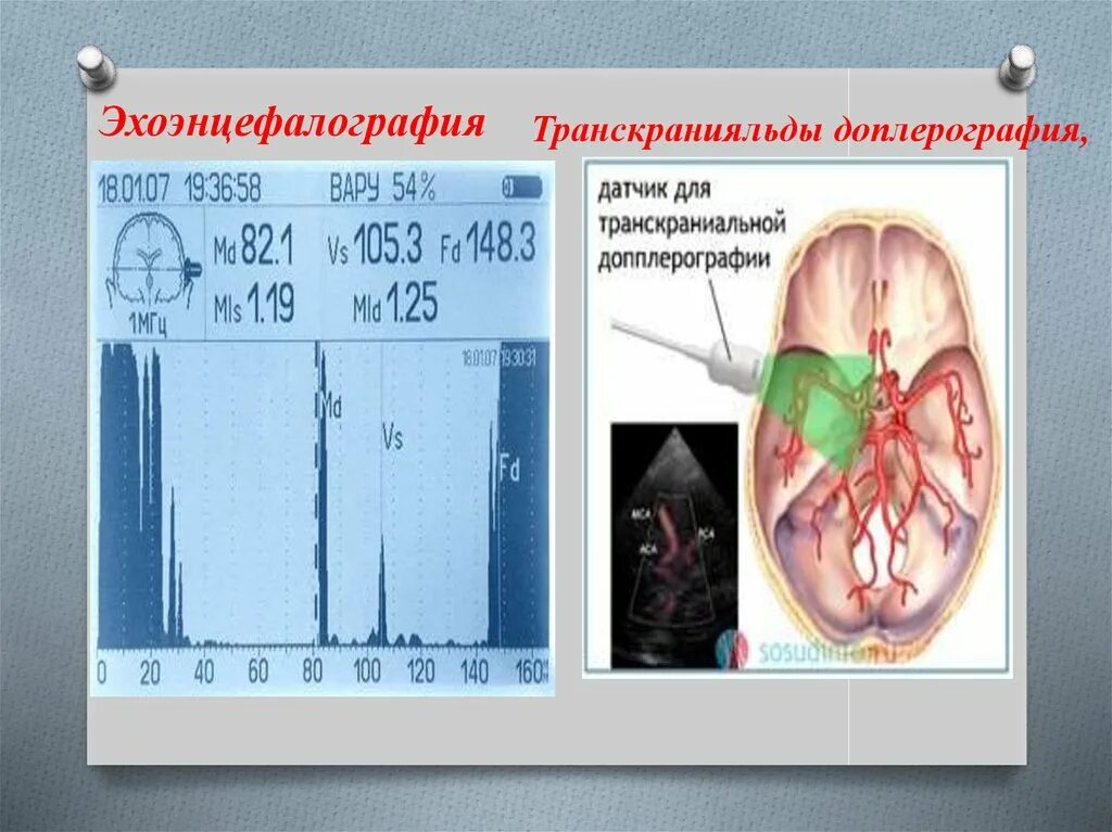 Эхо гостомеля. Эхоэнцефалография. Эхоэнцефалография УЗИ. Эхоэнцефалограмма норма. Одномерная эхоэнцефалография.