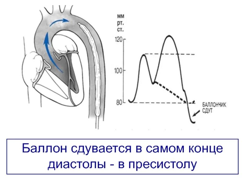 Показывает ли экг сердечную недостаточность. Кардиогенный шок экг. экг при кардиогенном шоке. экг при кардиогенном шоке изменения. окс кардиогенный шок экг.