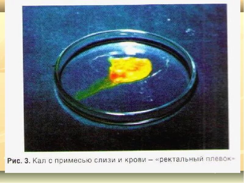 Вид кола при дизентерии. Вид кала при дизентерии. Стул при дизентерии в виде. Кал на поверхности воды