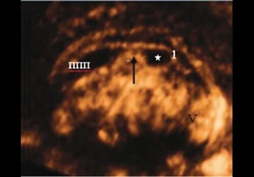 Полость Верге у плода на УЗИ. Киста сосудистого сплетения УЗИ. Полость промежуточного паруса УЗИ. Полость промежуточного паруса у плода.
