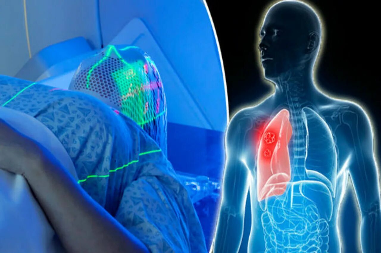 паллиативная лучевая терапия. лучевая терапия базалиомы. химия терапия при онкологии легких. лучевая химиотерапия рака легких. адъювантная лучевая терапия.