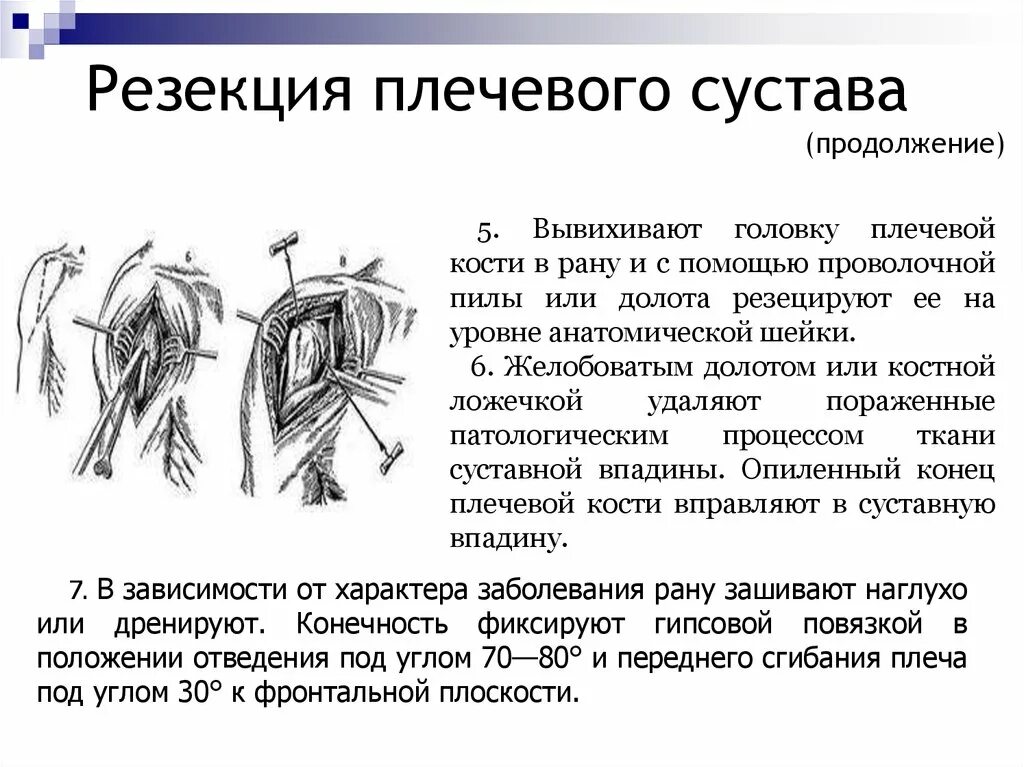 Краевая резекция пластины. Резекция плечевой кости. резекция головки плечевой кости. резекция плечевого сустава. чрезнадкостничная резекция кости.
