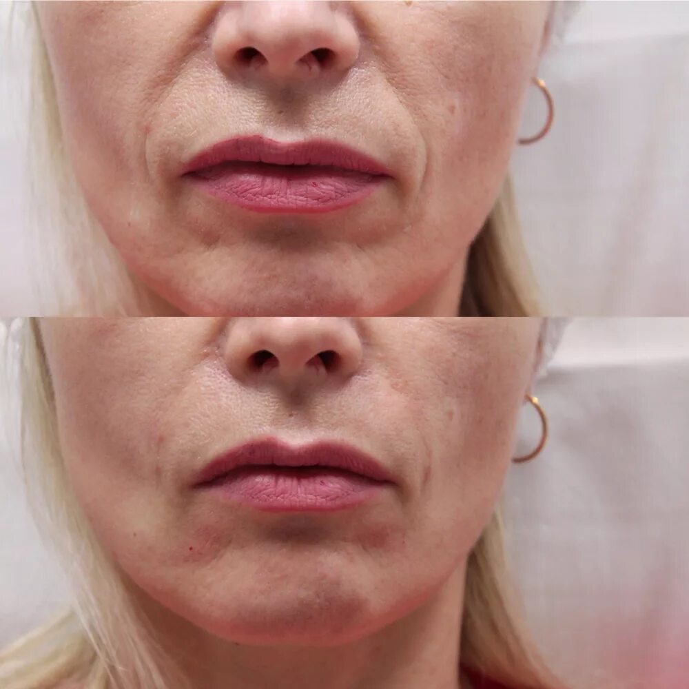 Носогубные складки. Филлеры в носогубные складки. Коррекция носогубных складок. Уколы для носогубных складок. Носогубные складки.
