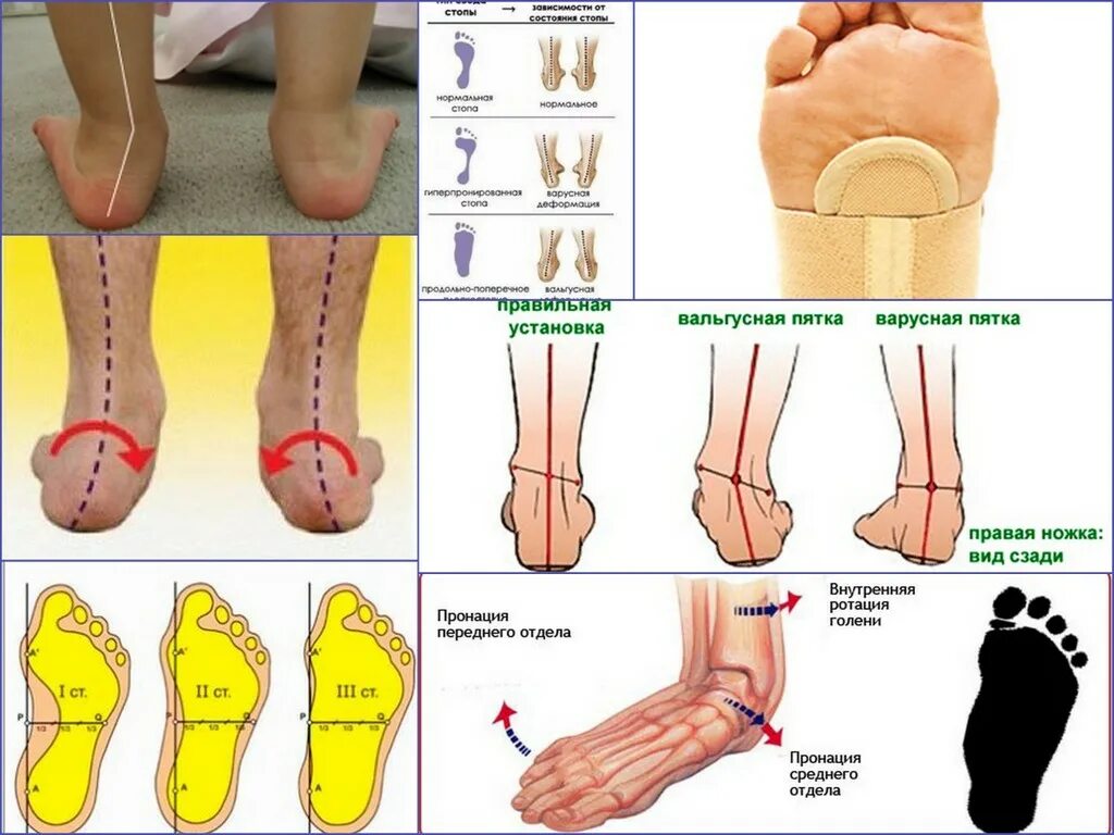 Когда можно ставить на ножки. Плоскостопие с вальгусной деформацией стопы. Вальгус вальгус плоскостопие. Плоскостопие вальгусная стопа у ребенка. Плоско вальгусная деформация ног.
