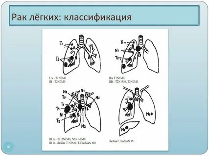 Схема рака легкого
