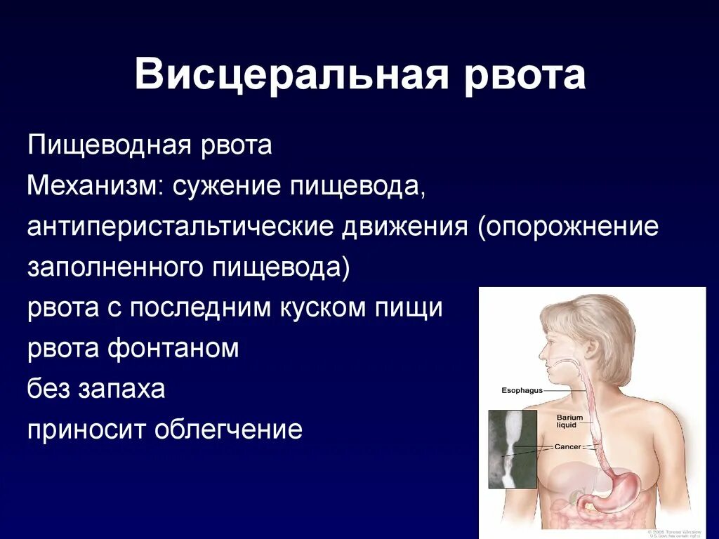 Висцеральная рвота. Висцеральная рвота механизм. Пищеводная рвота. Механизм пищеводной рвоты. Рвота повторяется