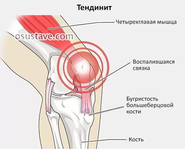 Тендинит коленных связок. Тендинит четырехглавой мышцы коленного сустава. Тендинит бурсит коленного сустава. Тендинит сухожилия надколенника. Тендинит связки надколенника.