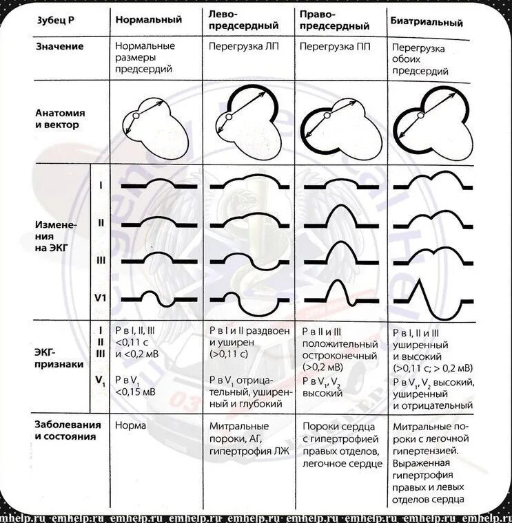 Перегрузка левых отделов сердца на ЭКГ. Перегрузка правых отделов сердца по ЭКГ. Гипертрофия правых отделов сердца на ЭКГ. Признаки перегрузки левых отделов сердца на ЭКГ. Перегрузка на экг что это
